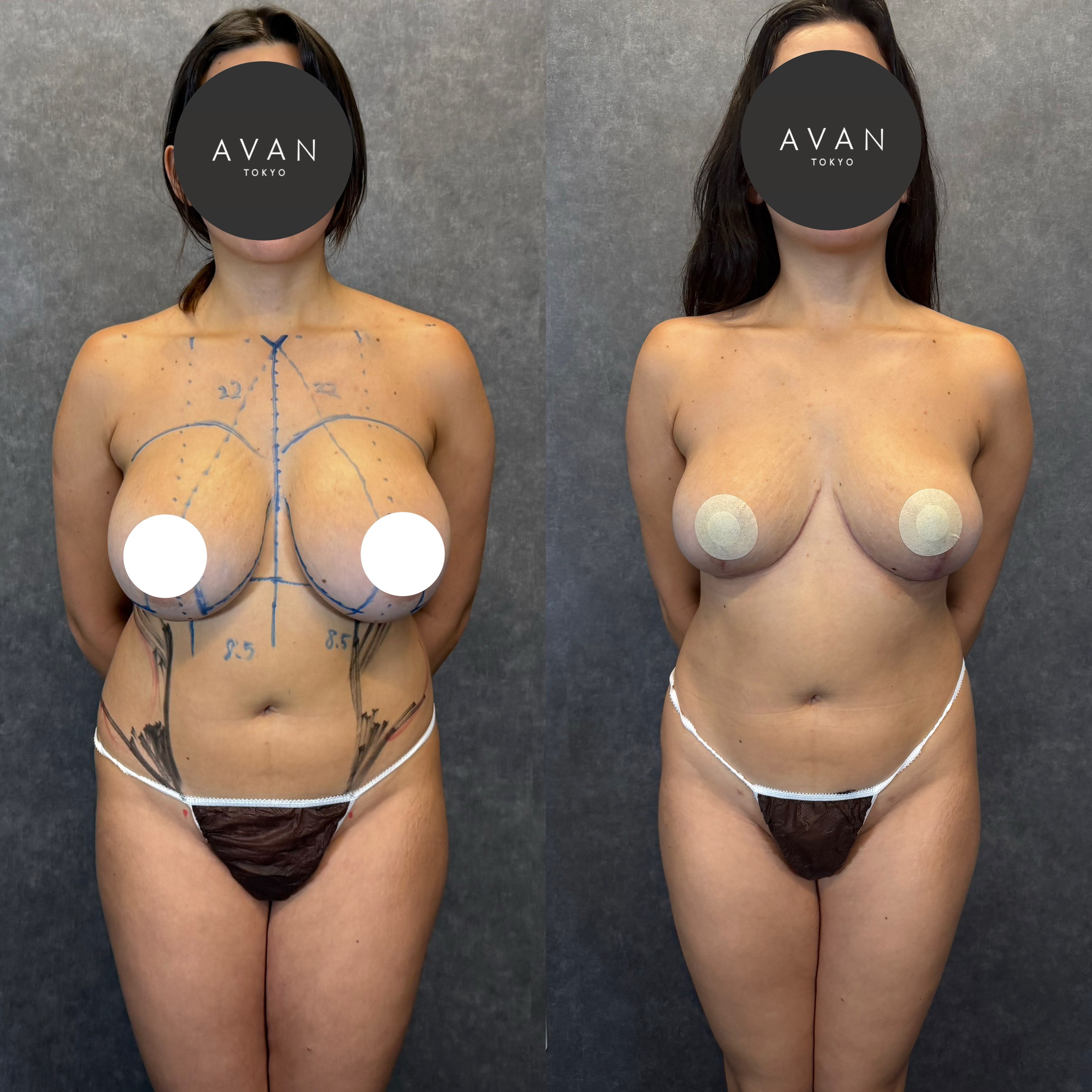 乳房縮小・吊り上げ＋シリコンバッグ入れ替え・側腹部脂肪吸引 ビフォーアフター（左：術前マーキング／右：術後2ヶ月） 26歳女性