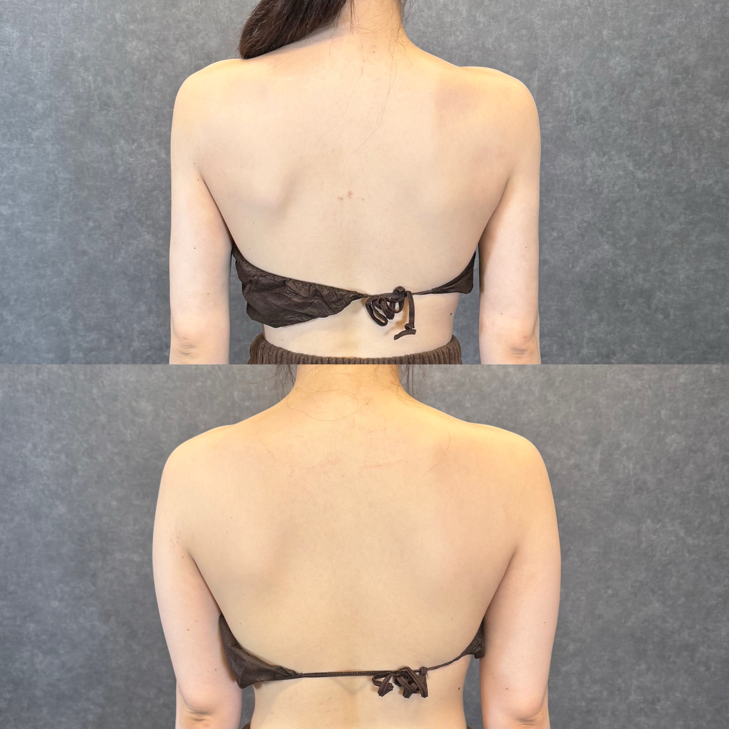 二の腕全周+前腕+副乳+肩甲骨上下・首下の脂肪吸引+ボトックス ビフォーアフター(後面) 26歳女性 術後6ヶ月
