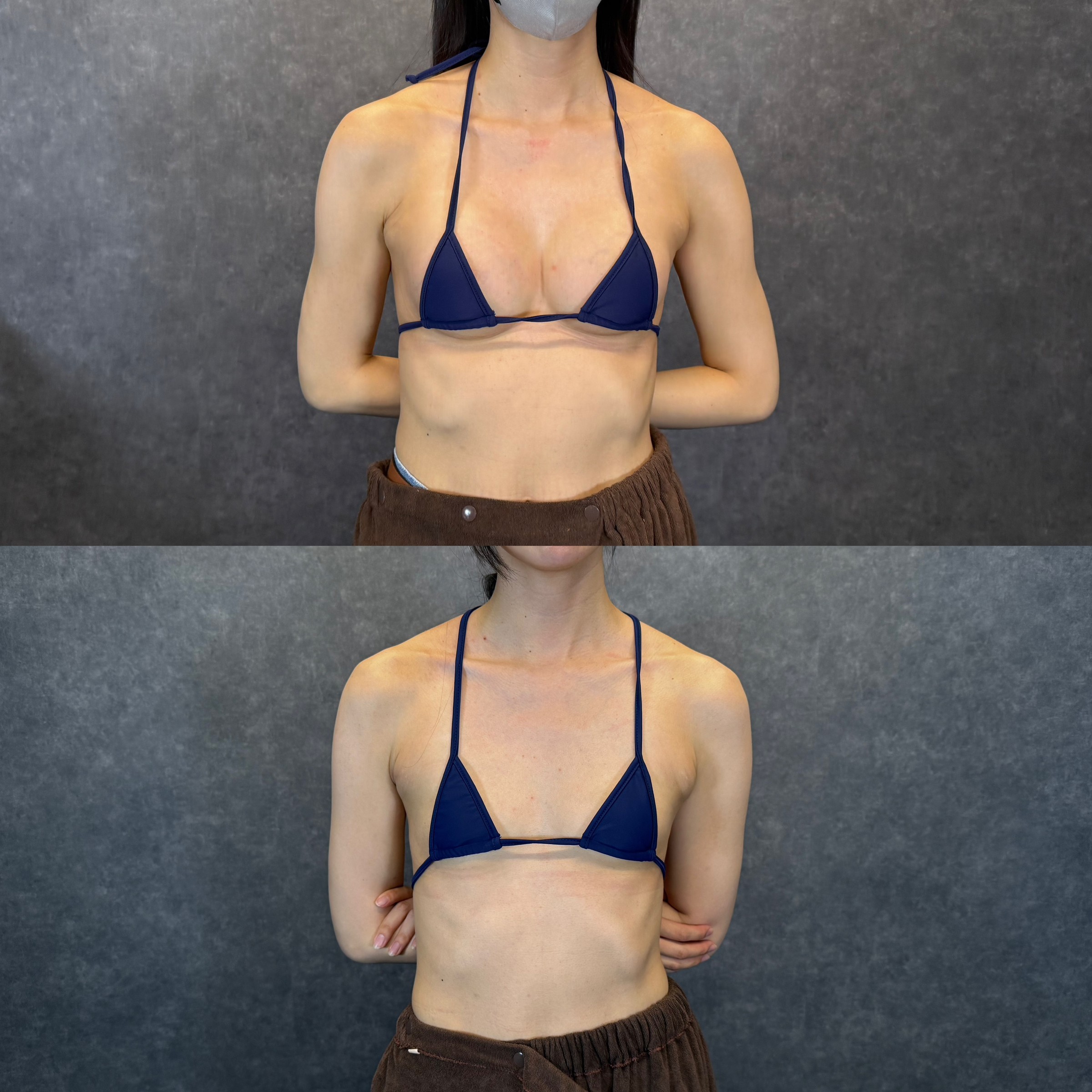 ハイブリッド豊胸＋二の腕・脇肉・副乳の脂肪吸引 ビフォーアフター（正面） 32歳女性 術後6ヶ月