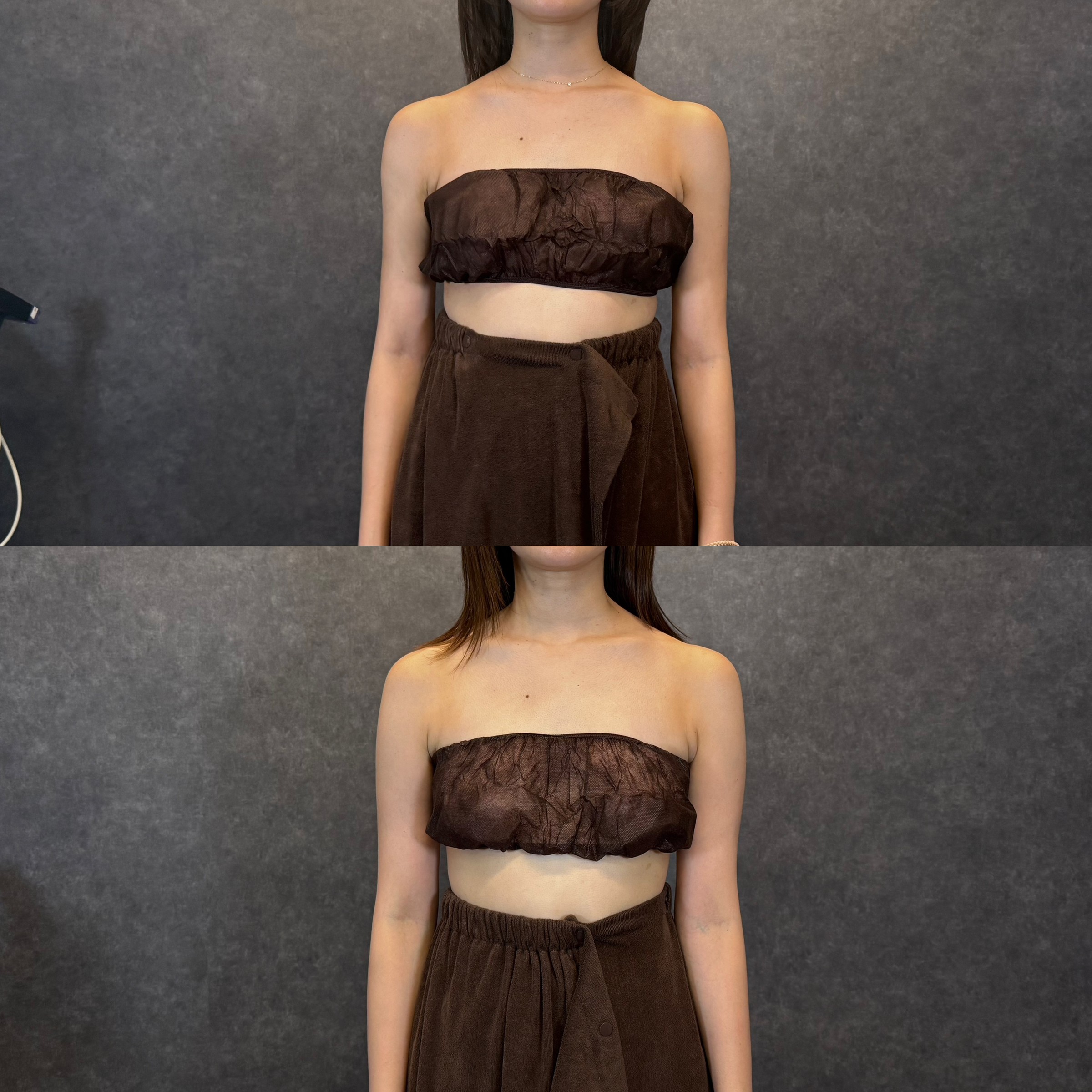 二の腕全周＋副乳の脂肪吸引 ビフォーアフター（正面） 34歳女性 術後2ヶ月