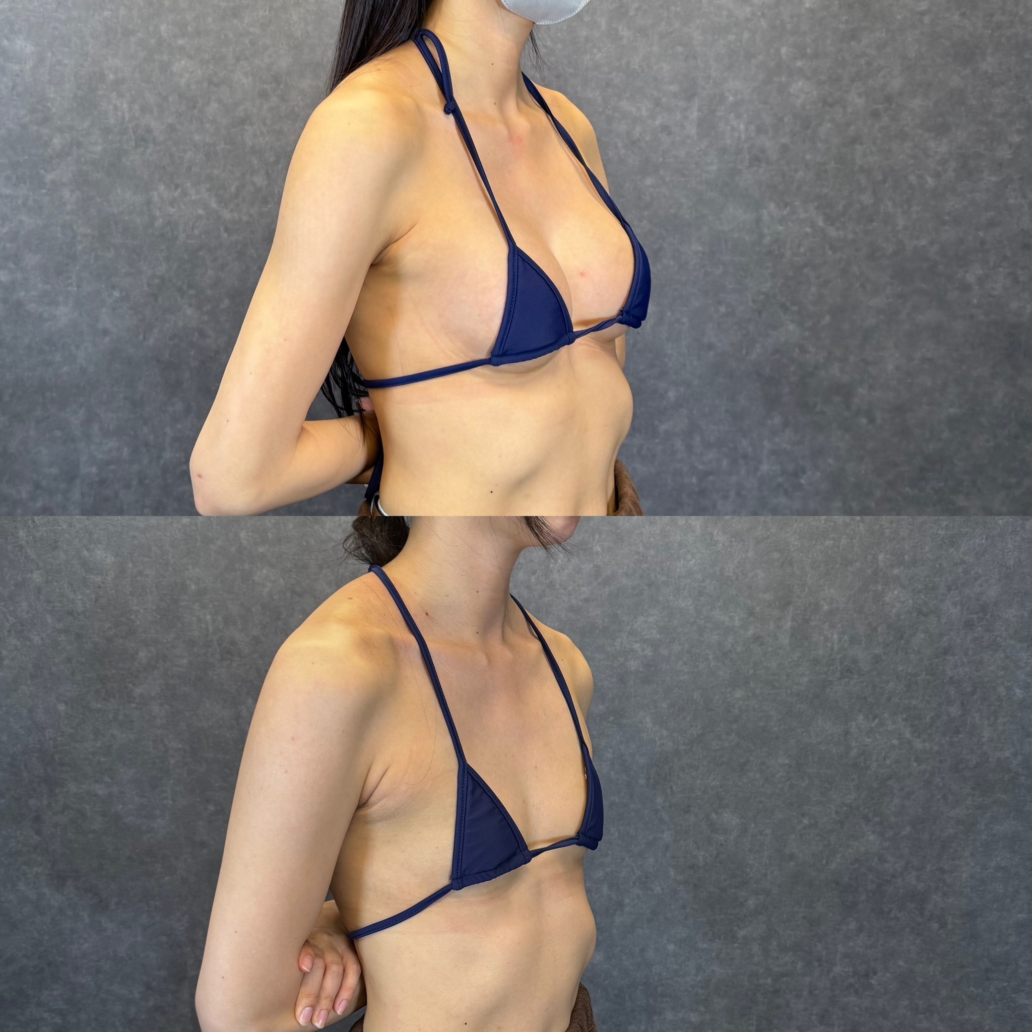 ハイブリッド豊胸＋二の腕・脇肉・副乳の脂肪吸引 ビフォーアフター（斜め） 32歳女性 術後6ヶ月