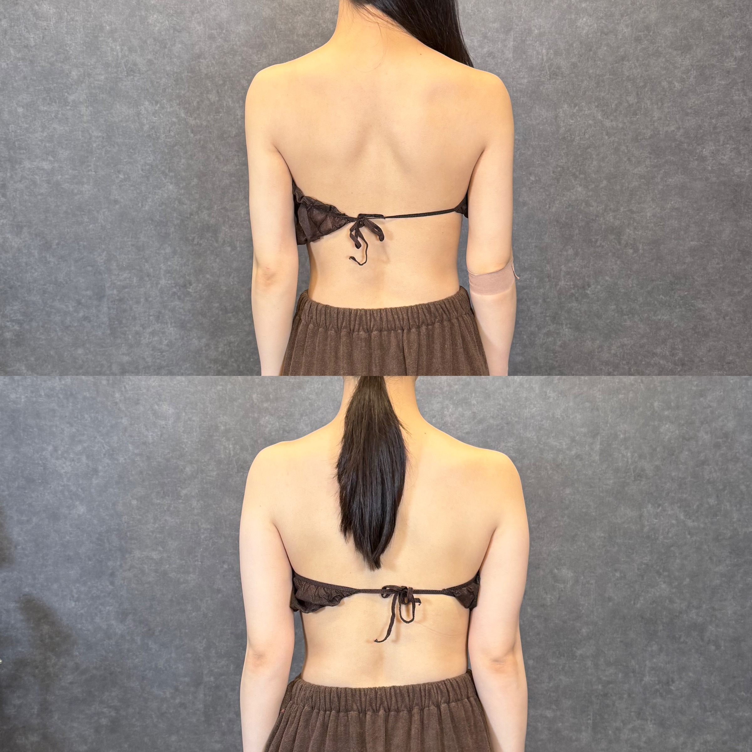 二の腕全周＋太もも全周の脂肪吸引＋ふくらはぎボトックス ビフォーアフター（後ろ姿・二の腕） 24歳女性 術後2ヶ月
