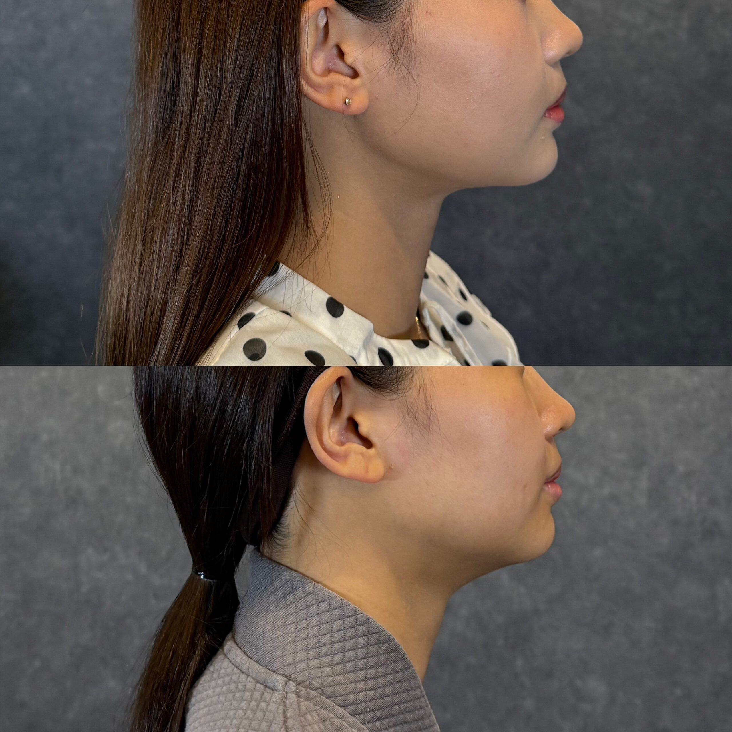 顎下の脂肪吸引＋首のバイニードル＋顎のヒアルロン酸注入 ビフォーアフター（側面） 22歳女性 術後2ヶ月