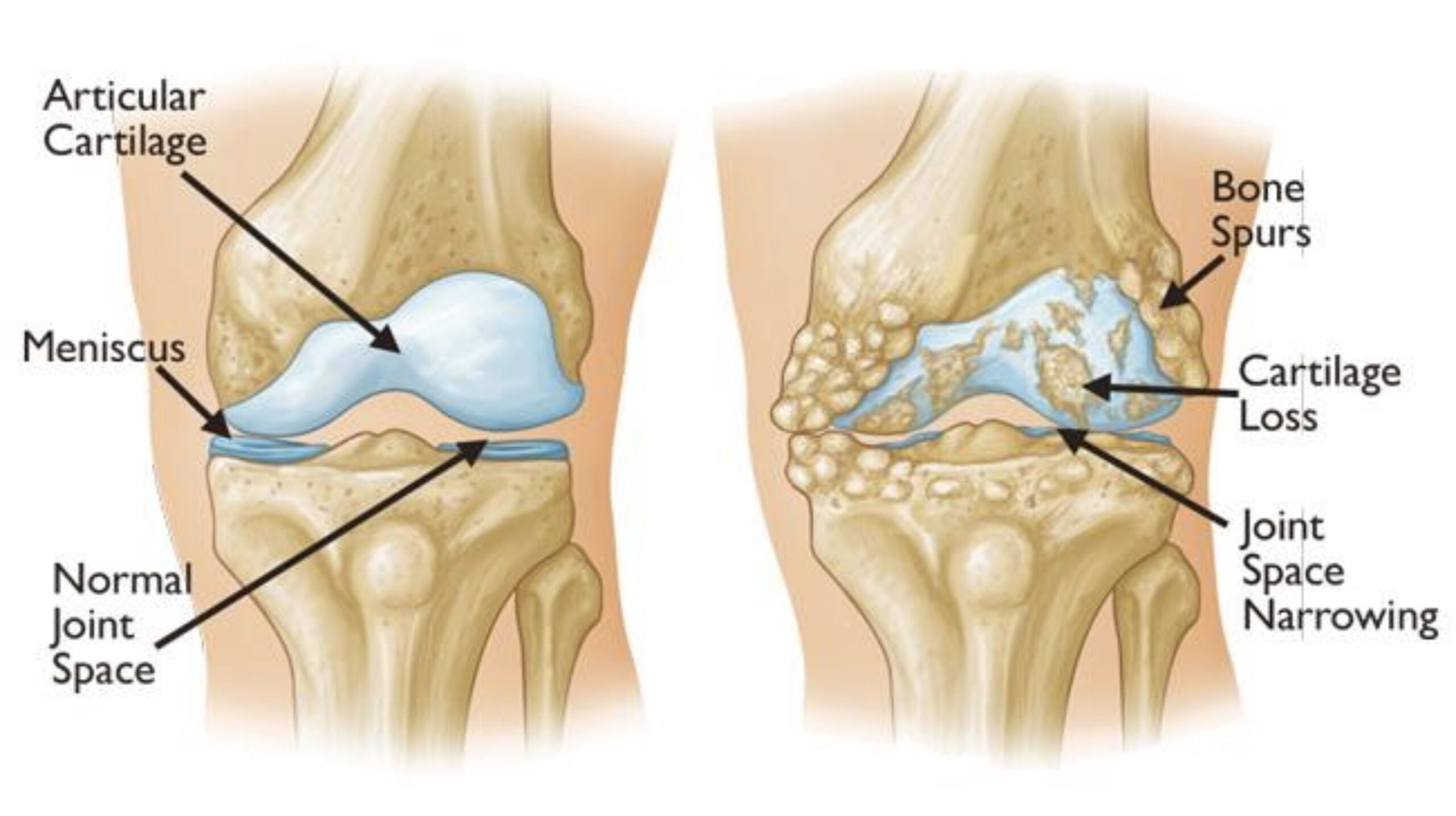 elbow UCL ulnar collateral ligament thrower
