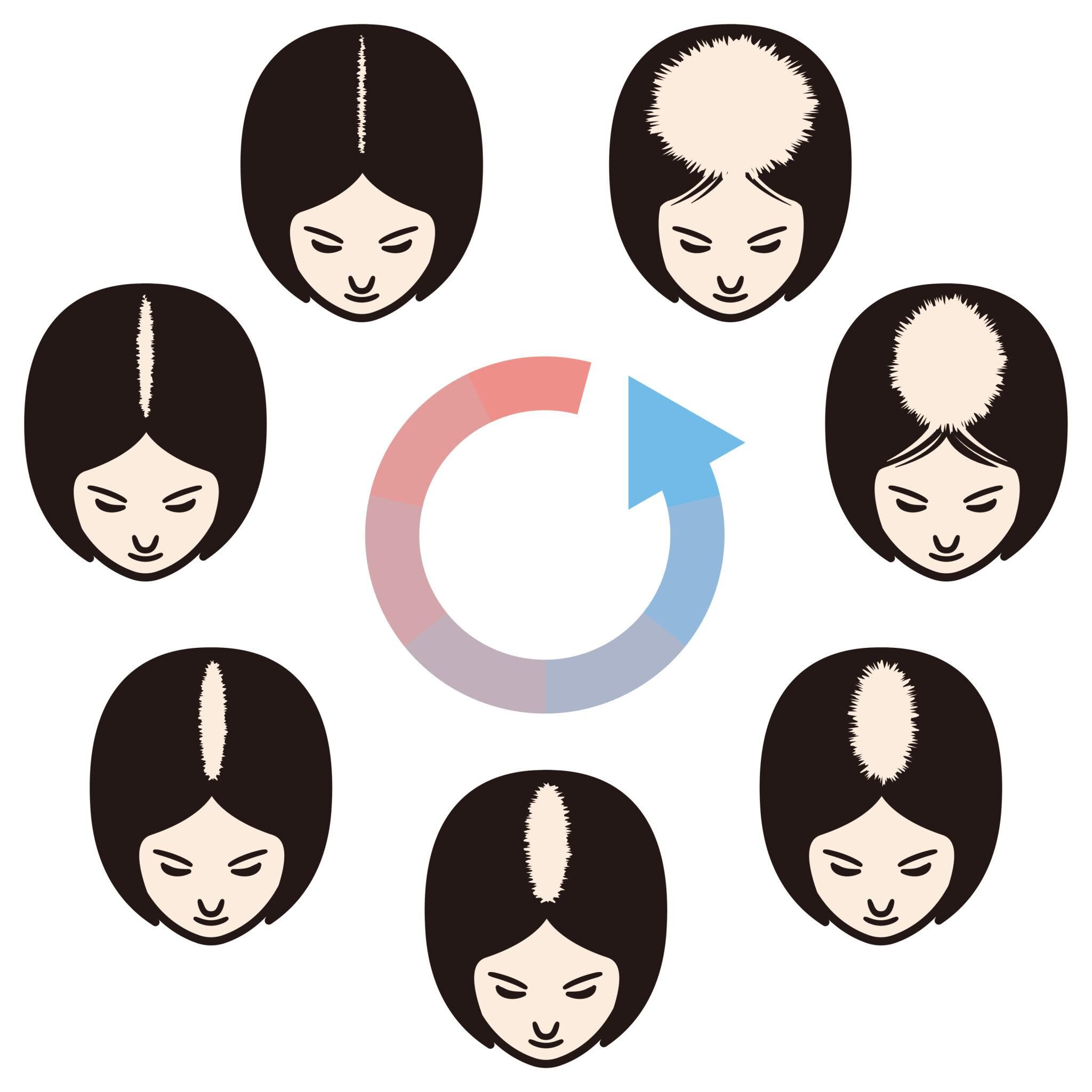telogen effluvium hair loss scalp diagnosis