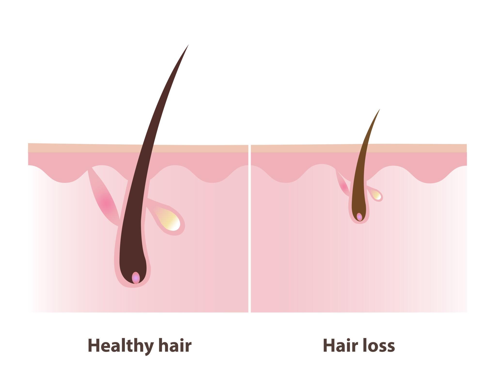 scalp microbiome shampoo hair loss